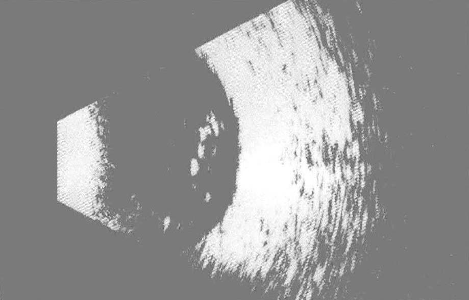 三、玻璃體星狀變性